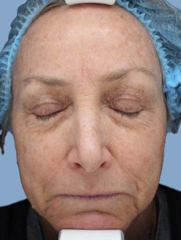 Case # 38 before photo