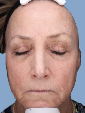 Case # 38 after photo