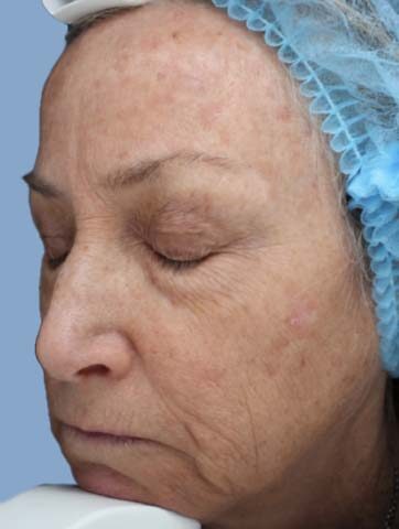 Case # 38 before photo