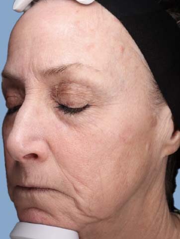 Case # 38 after photo