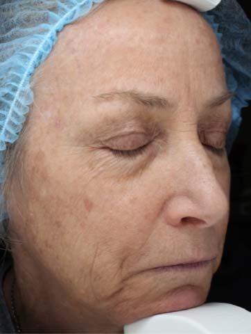 Case # 38 before photo