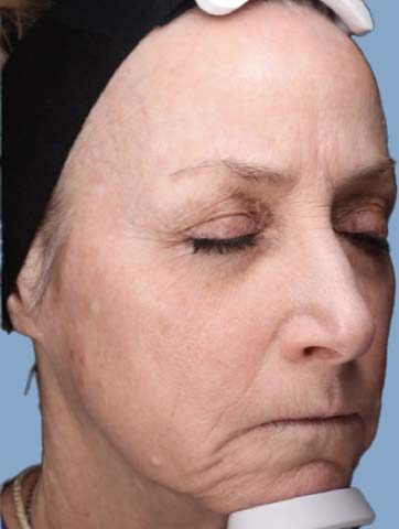 Case # 38 after photo