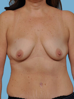 Case # 41 before photo