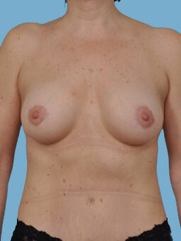 Case # 41 after photo