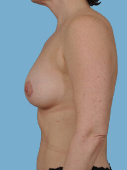 Case # 41 after photo