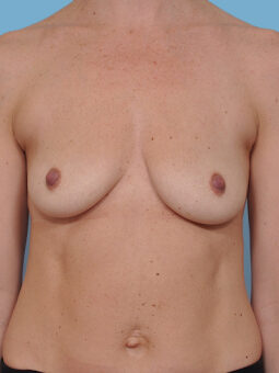 Case # 42 before photo