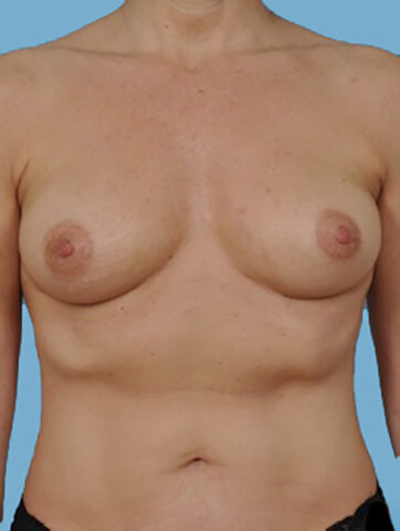 Case # 11 after photo