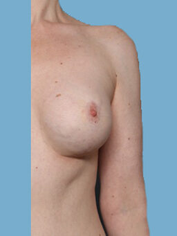 Case # 43 after photo