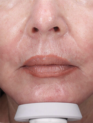 Case # 39 after photo