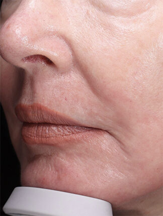 Case # 39 after photo