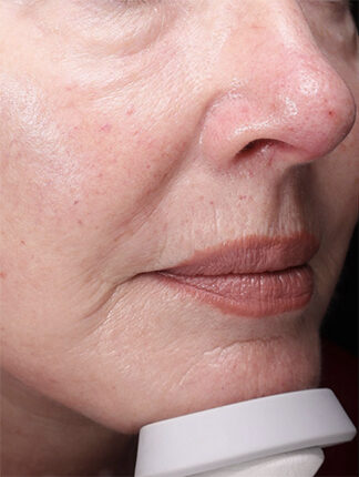 Case # 39 before photo