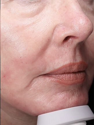 Case # 39 after photo