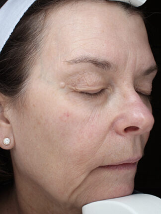 Case # 42 before photo