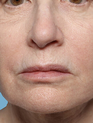 Case # 44 before photo