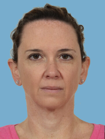 Case # 1 before photo