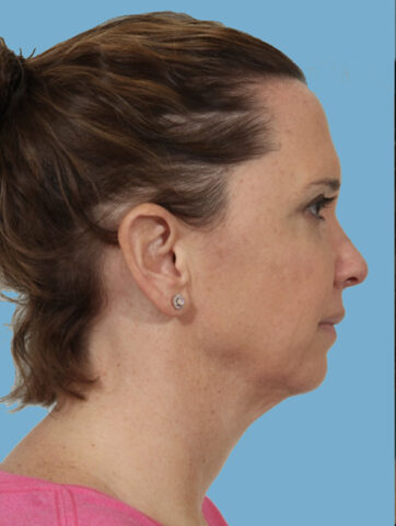 Case # 1 before photo