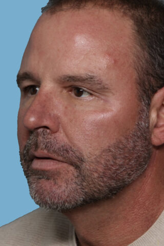 Case # 1 after photo