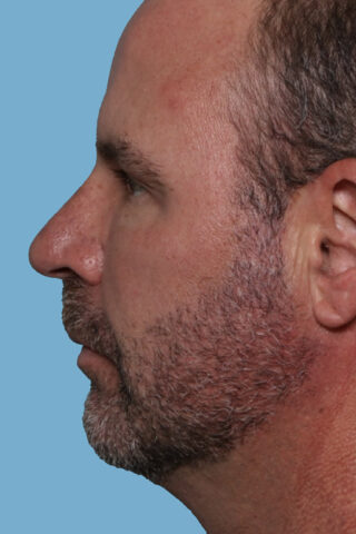 Case # 1 after photo