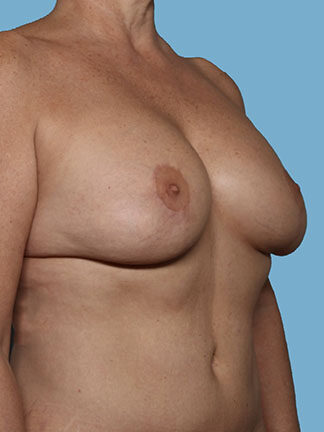 Case # 4 after photo