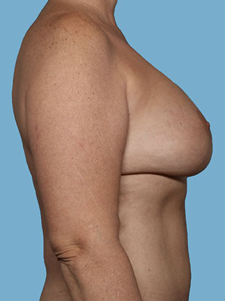 Case # 4 after photo