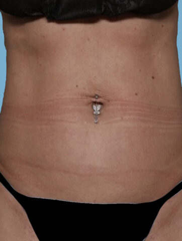 Case # 24 after photo