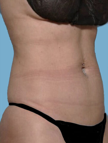 Case # 24 after photo