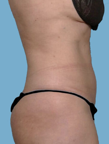 Case # 24 after photo