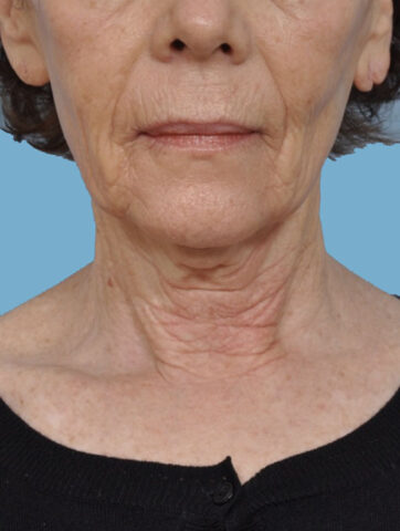 Case # 2 before photo