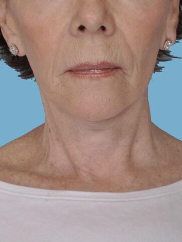 Case # 2 after photo