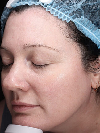 Case # 45 after photo