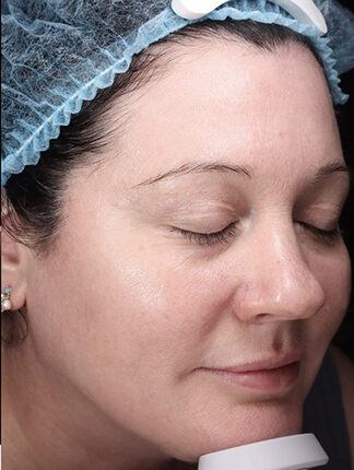 Case # 45 after photo