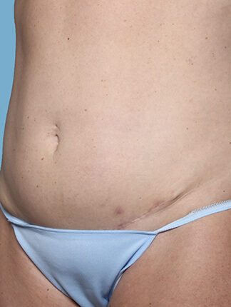 Case # 46 before photo