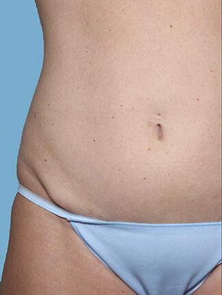 Case # 46 before photo