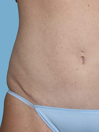 Case # 46 after photo