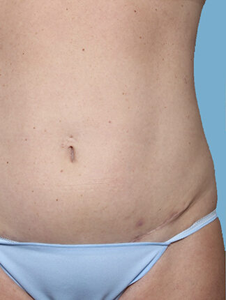 Case # 46 before photo