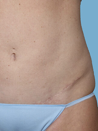 Case # 46 after photo