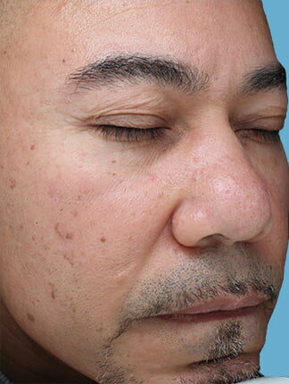 Case # 47 before photo