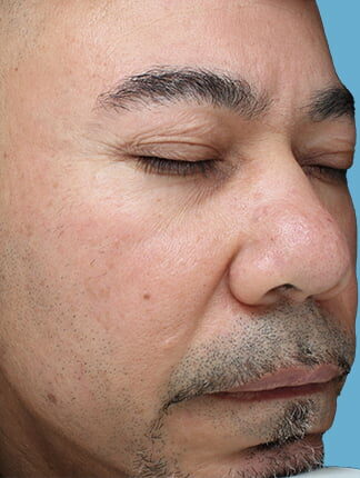 Case # 47 after photo