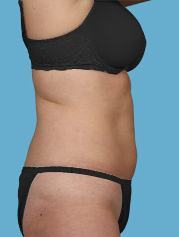 Case # 25 after photo