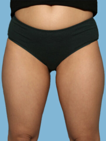 Case # 26 after photo