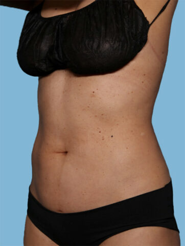 Case # 27 after photo