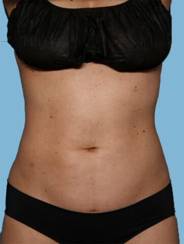 Case # 27 after photo