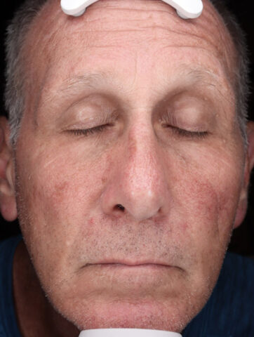 Case # 48 before photo