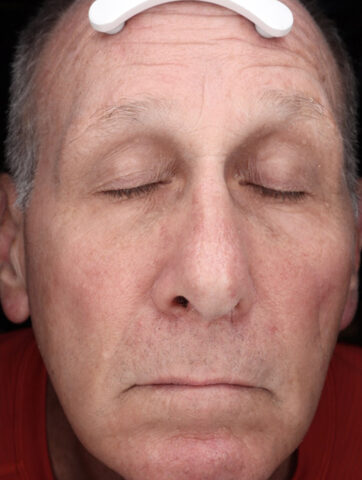 Case # 48 after photo