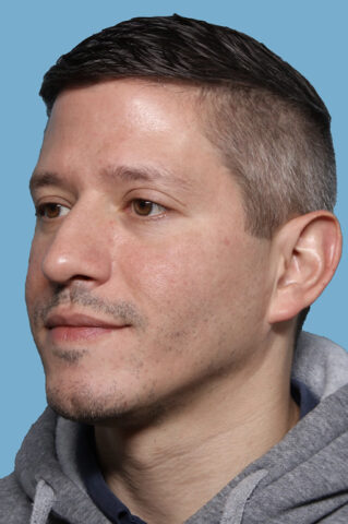 Case # 49 after photo