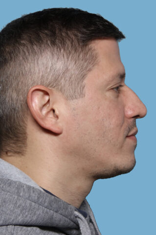 Case # 49 after photo