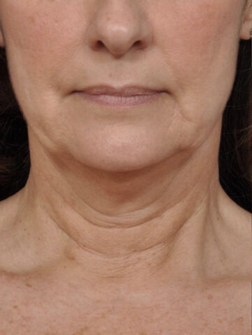 Case # 1 before photo