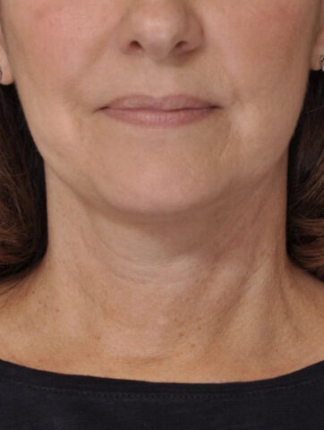 Case # 1 after photo