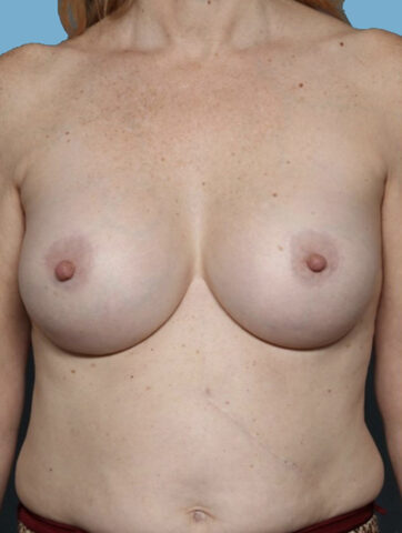 Case # 44 after photo