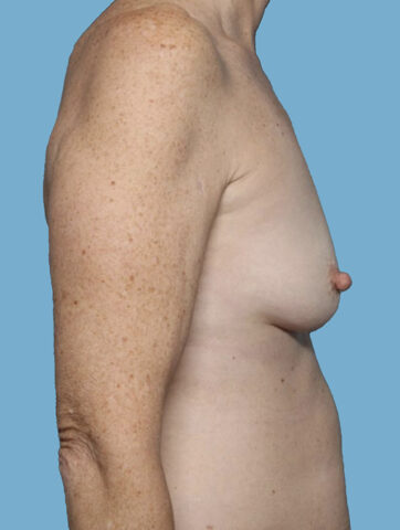 Case # 44 before photo